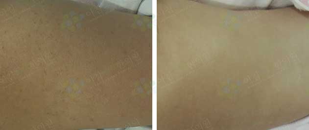 팔모공각화증 전후사진